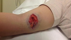 pitbull-attack-arm-injury